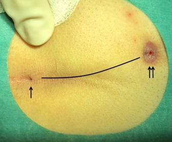 OP laser therapy pilonidal cyst (sinus pilonidalis)