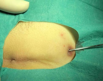 OP laser therapy pilonidal cyst (sinus pilonidalis)