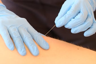 PhysioPlus Widnau, Dry Needling sehr erfolgreich bei Nackenverspannungen, Schulterschmerzen, Rückenschmerzen, Kopfschmerzen, Tennisarm