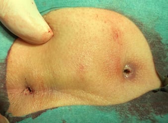 OP laser therapy pilonidal cyst (sinus pilonidalis) result