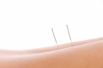 Akupunktur stellt eine wunderbar ergänzende Methode in der schmerztherapeutischen Behandlung von Störungen des Bewegungsapparates aber auch von stressbedingten Störungen der Muskel, Sehnen, Gelenke und Knochen dar. COPV Berlin