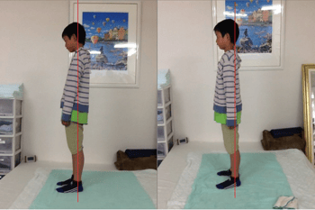 左:施術前 右:施術後