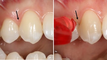ParoSphère | Brossette interdentaire. Photo: © ParoSphère.