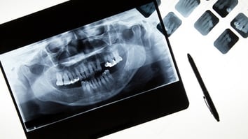 ParoSphère | Antécédent de parodontite. Crédit photo : © alice_photo