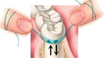 ParoSphère | Fil dentaire. Crédit photo : inconnu.