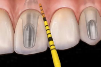 Sonde en plastique pour le sondage péri-implantaire.