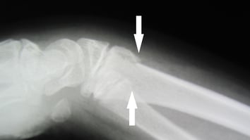 右橈骨尺骨骨折　保存療法　国分寺こみね鍼灸整骨院