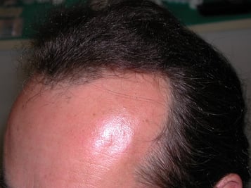 Trapianto capelli FUE-DHI Padova