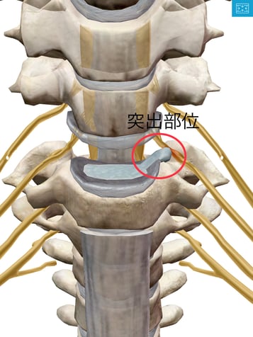 頸椎ヘルニア　首の痛み