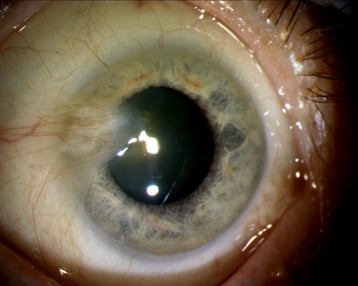 Pterygium vor Operation