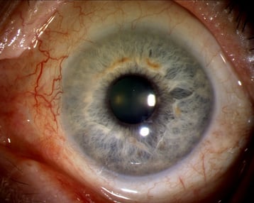 dasselbe Auge 3 Monate nach Operation mit Transplantat der Bindehaut.