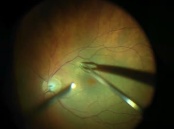 Angefärbte Membran in der Netzhautmitte (Indocyaningrün)   