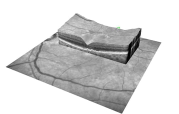 Nach erfolgreicher operativer Versorgung. Das Makulaforamen ist verschlossen. Die anatomischen Strukturen sind wiederhergestellt.