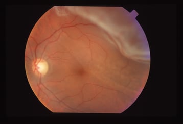 Netzhautablösung im oberen äußeren Bereich (unscharfer Bereich) mit Abhebung bis kurz vor die Makula (Stelle des schärfsten Sehens, leicht dunkel im Zentrum)