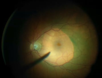 Entfernte Membranen (nicht grüner Anteil) in der Netzhautmitte