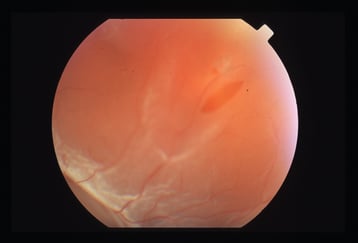 Netzhautablösung mit Lochbildung