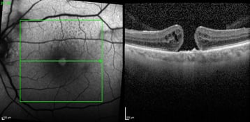 durchgreifendes Makulaforamen im OCT Querschnitt