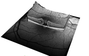 en  3D Darstellung eines durchgreifenden Makulaforamens