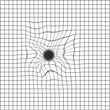 Gerade Linien sind verbogen und krumm, zentral zeigt sich eine gräuliche Veränderung im Gesichtsfeld. Hier liegt eine Erkrankung der Makula vor. Eine weitere diagnostische Abklärung ist dringend zu empfehlen. 