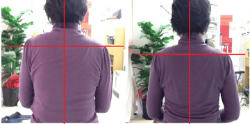 左:施術前 右:施術後