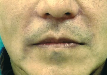 ヒアルロン酸治療後０２