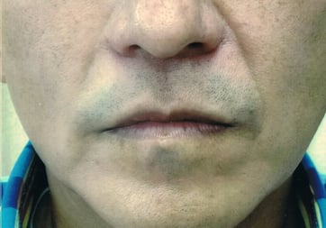 ヒアルロン酸治療前０２