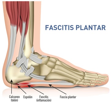 Fascitis plantar