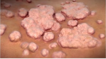 Kondylome flächenhaft im Anoderm (Bild der Firma Biolitec) - Proktologie Berlin