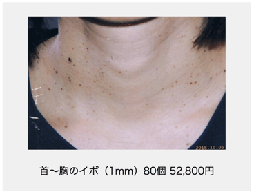 首から胸のイボ
