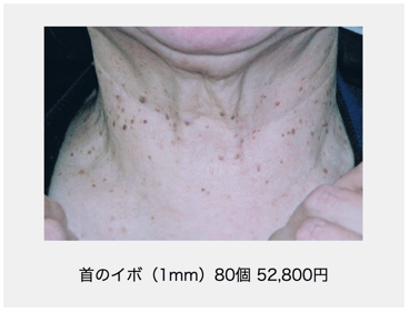 首のイボ