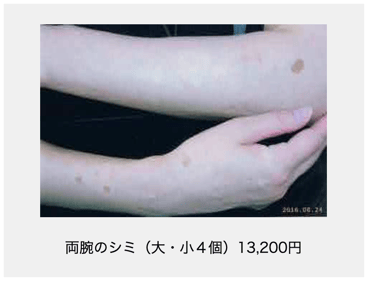両腕のシミ