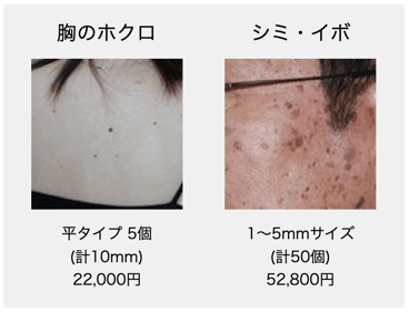 胸のホクロ、顔のシミ・イボ