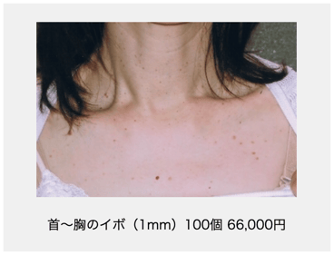 首から胸のイボ