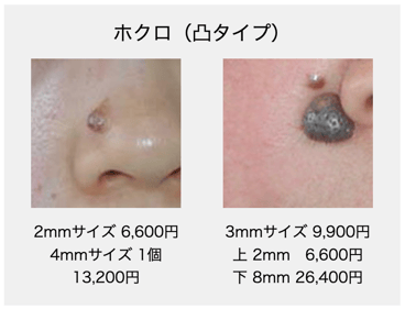 ホクロ（凸タイプ）