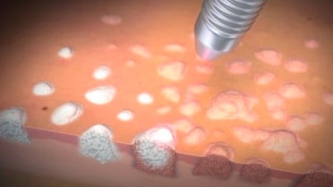 Laserbehandlung der Kondylome flächenhaft im Anoderm (Bild der Firma Biolitec) - Proktologie Berlin