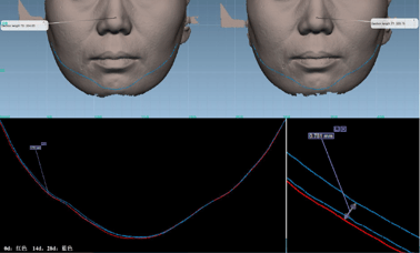 下顎のたるみの観察画像