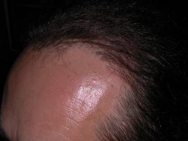 Trapianto capelli FUE-DHI PADOVA