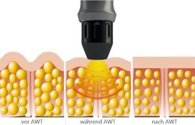 Anti Cellulite, Kosmetik Eich, Stosswelle, medizinisch, Reduktion von Cellulite, glattere Haut, Fettdepots, strafffe Haut, AWT, Oberschenkel, Arme, Po, Gesäss, Kosmetik Studio, Sempachersee