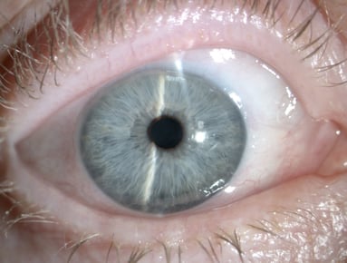 Filterkissenbereich nach XEN am oberen Rand der Bindehaut rechts bei 1-2 Uhr