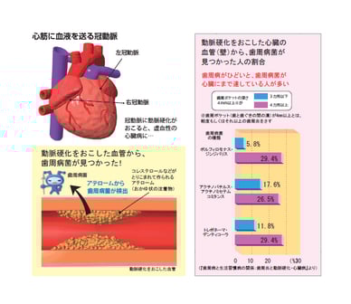 歯周病と動脈硬化