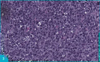 Coloration hématéine-safran-éosine d'une prolifération maligne indifférenciée mitotique