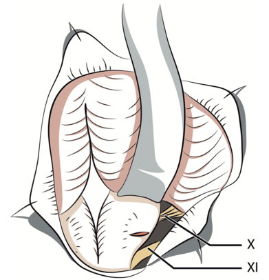Fig. 5 – Incision du bulbe dans la tractotomie trigéminale de Sjöquist, d’après [17]. X : nerf pneumogastrique, XI : nerf spinal