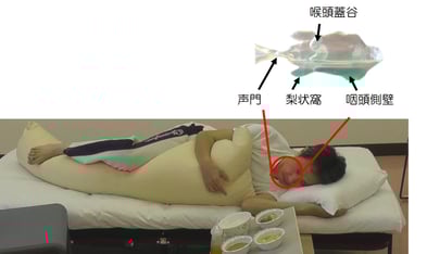 完全側臥位では声門より下の咽頭側壁に食塊がたまり誤嚥しない。