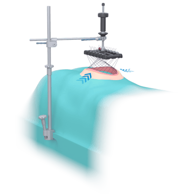 Fasciotens Hernia Produktfoto 