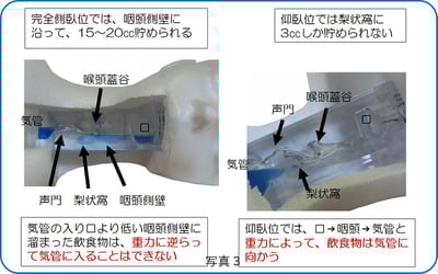 喉の構造から比較すると完全側臥位の方が仰臥位より安全なのが分かる