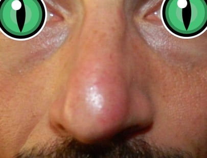 rinoplastica senza chirurgia