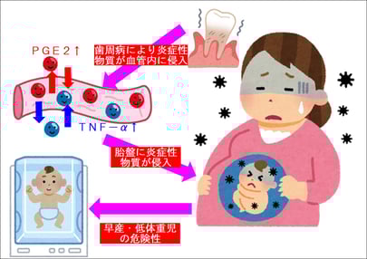 歯周病による妊娠への悪影響（早産・低体重児）