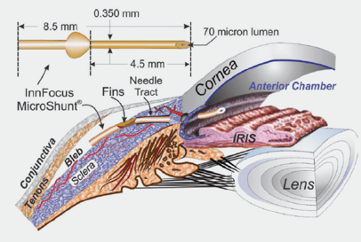 Schematische Darstellung des Preserflo-Stents mit Maßen oben links, rechts unten optimale Lage im Kammerwinkel