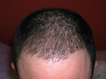 Trapianto capelli FUE-DHI Padova