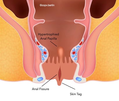 Anal fissure - proctology berlin copv